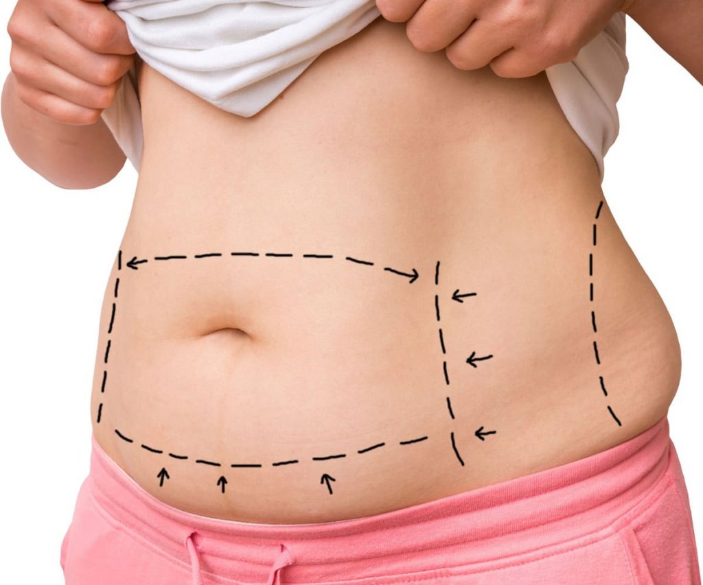 TUMMY TUCK